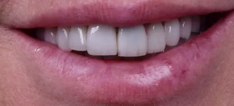 Antes: lentes de porcelana antigas, com formato pesado