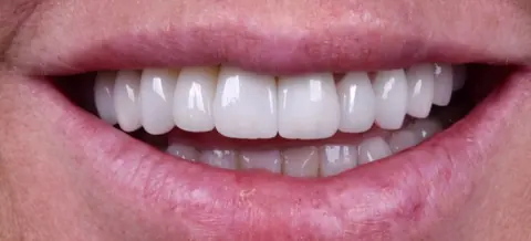 Sorriso depois da troca das lentes de porcelana