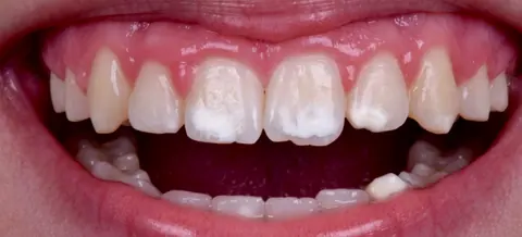 Antes: manchas brancas nos dentes da frente