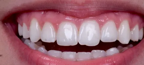 Depois: dentes com cor uniforme