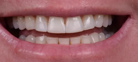 Antes: resinas antigas e amareladas
