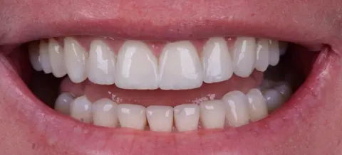 Depois: resinas novas, no mesmo tamanho de dente