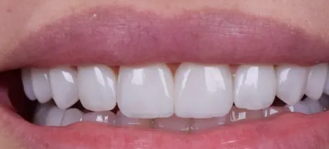 Depois das facetas em resina composta