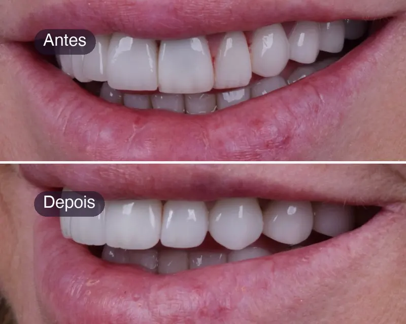 Antes e depois de lentes de porcelana em seis dentes superiores