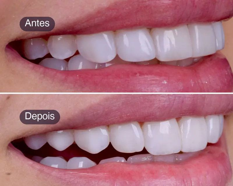 Antes e depois de facetas em resina composta, vista de perfil