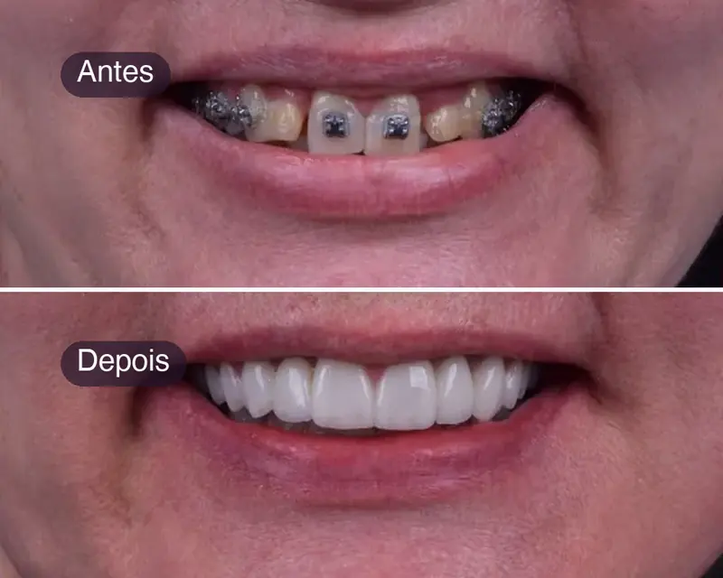 Antes e depois de uma reabilitação oral completa