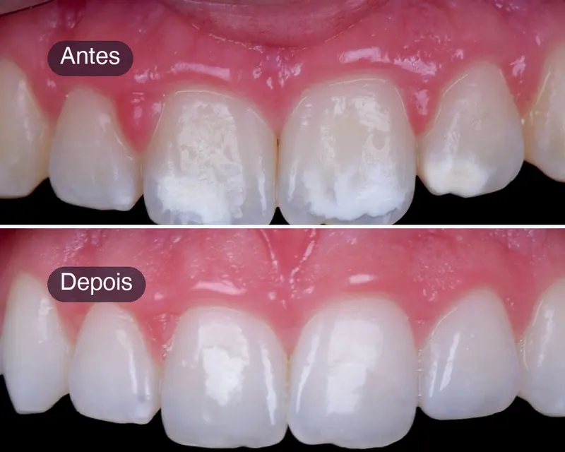 Antes e depois do tratamento de manchas brancas no esmalte