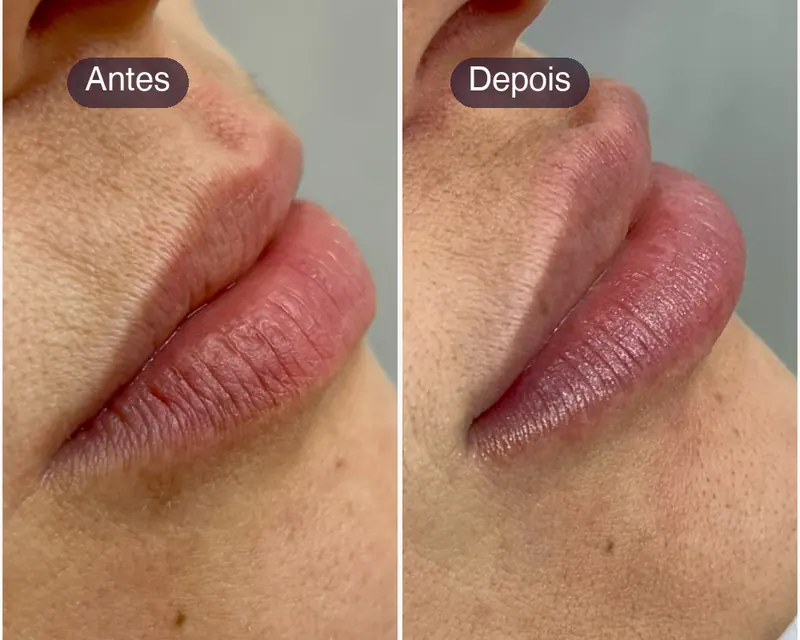 Antes e depois de preenchimento labial, de perfil